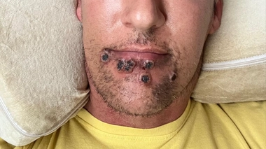 En France, 1567 cas de variole du singe ont été recensés depuis début mai