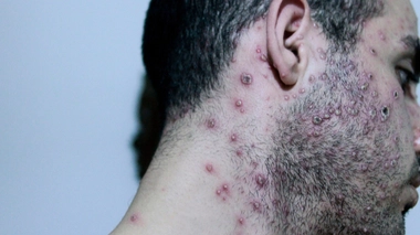 "Variole du singe" : ce que l'on sait des premiers décès hors d'Afrique