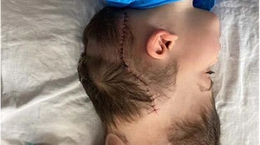 Quand la réalité virtuelle permet de séparer des siamois liés par le crâne