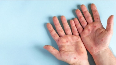 Variole du singe : quels sont les symptômes ?