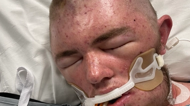 Austin Bellamy, 20 ans, a été piqué 20 000 fois par des "abeilles tueuses"