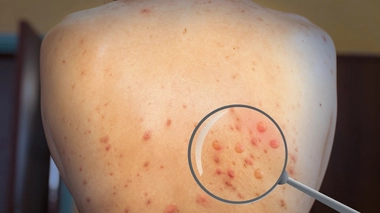 La variole du singe se traduit par une forte fièvre et évolue rapidement en éruption cutanée