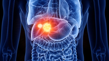 Le cancer du foie est souvent dépisté tard car il ne provoque pas de symptômes dès le départ