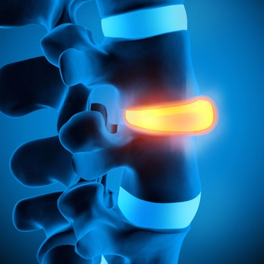 Hernie discale : quand le disque ne tourne plus rond