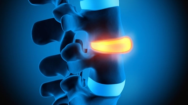 Hernie discale : quand le disque ne tourne plus rond