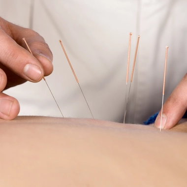 L'acupuncture est une discipline millénaire