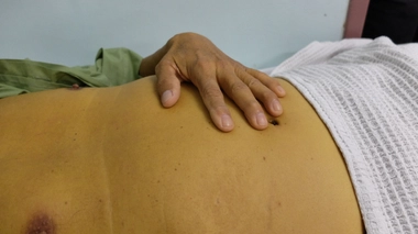 Un cluster d'hépatite A identifié en Europe