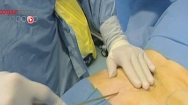 Sus à la liposuccion ?