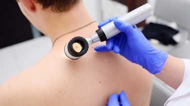 Mélanome : le plus redouté des cancers de la peau