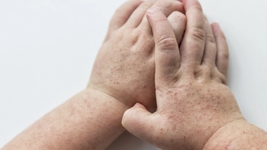 Les streptocoques A sont à l'origine de la scarlatine