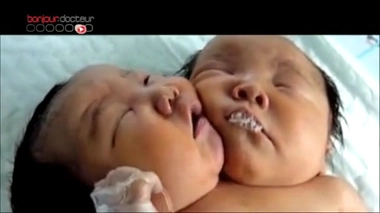 Naissance en Chine : deux têtes pour un corps