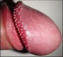 La couronne perlée se caractérise par la présence de petites billes blanches sur la ligne séparant le gland du reste du pénis