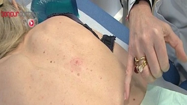 Mélanome, carcinome... surveillez votre peau !