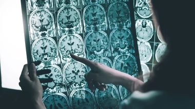 Minute Docteur ! Pourquoi la maladie d'Alzheimer porte- t-elle ce nom ?