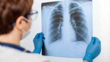 Décubitus ventral : une technique de réanimation qui sauve des vies