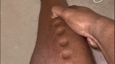 Lawrence Okoye a souffert d'une cellulite infectieuse