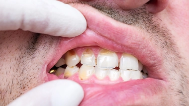 Ces mauvaises habitudes qui abîment nos dents et nos gencives