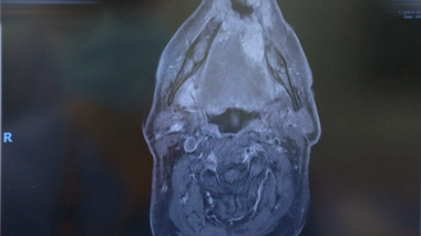 Cancer de la bouche : quelle chirurgie et quel traitement ?