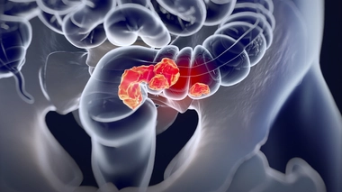 On vous explique quels sont les symptômes du cancer colorectal