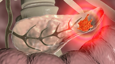 Le nombre de cancers du pancréas est en constante augmentation