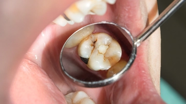 Montre-moi tes dents, je te dirai quel métier tu fais !