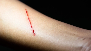 Des remèdes de grand-mère qui aggravent les blessures