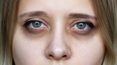 Les cernes peuvent se corriger grâce à des injections d'acide hyaluronique.