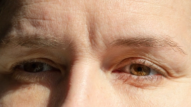 Les paupières qui tombent sont appelées ptosis par les médecins.