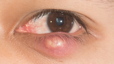 Le chalazion est un kyste de taille parfois impressionnante.