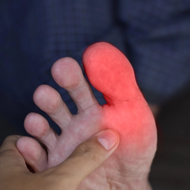 La goutte touche souvent le gros orteil mais peut toucher d'autres articulations.