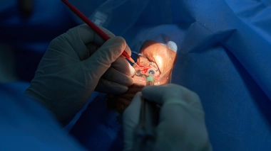 Le chirurgien pose un implant pour remplacer le cristallin malade.