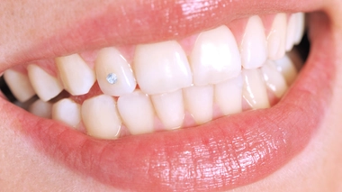 Le strass dentaire, une mode dangereuse pour vos dents ?