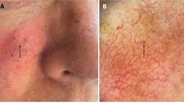 La tache sur la joue de Christy Staats est en fait un micro-mélanome in situ, le stage le plus précoce de mélanome