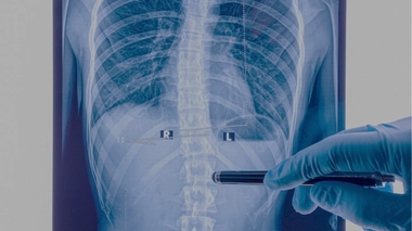 Scoliose : les traitements les plus étonnants