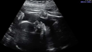 Pour éviter les risques de malformation, les chirurgiens ont proposé aux parents de participer à un essai clinique