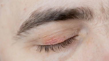 Cancer de la peau : protégez vos paupières !