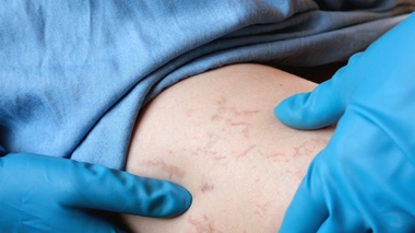 Varices : comment les prévenir ?