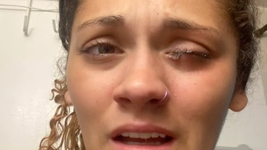 La jeune femme explique avoir tout bonnement confondu son collyre avec de la superglue en pleine nuit