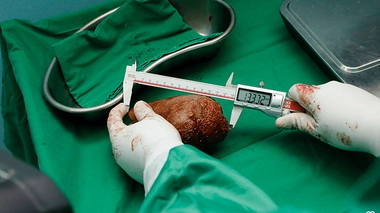 L'ancien sous-officier, âgé de 62 ans, s'est vu retirer un calcul rénal qui pesait 801 grammes, ont indiqué les médecins militaires