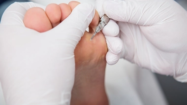 Comment prévenir l'apparition des cors aux pieds ?