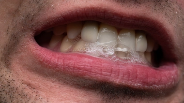 Que faire si on salive beaucoup ?