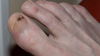 Comment traiter le mélanome sous-unguéal ?