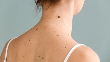 Apparition de grains de beauté : quand faut-il s'inquiéter ?
