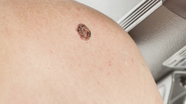 Quelle différence entre un carcinome et un mélanome ?