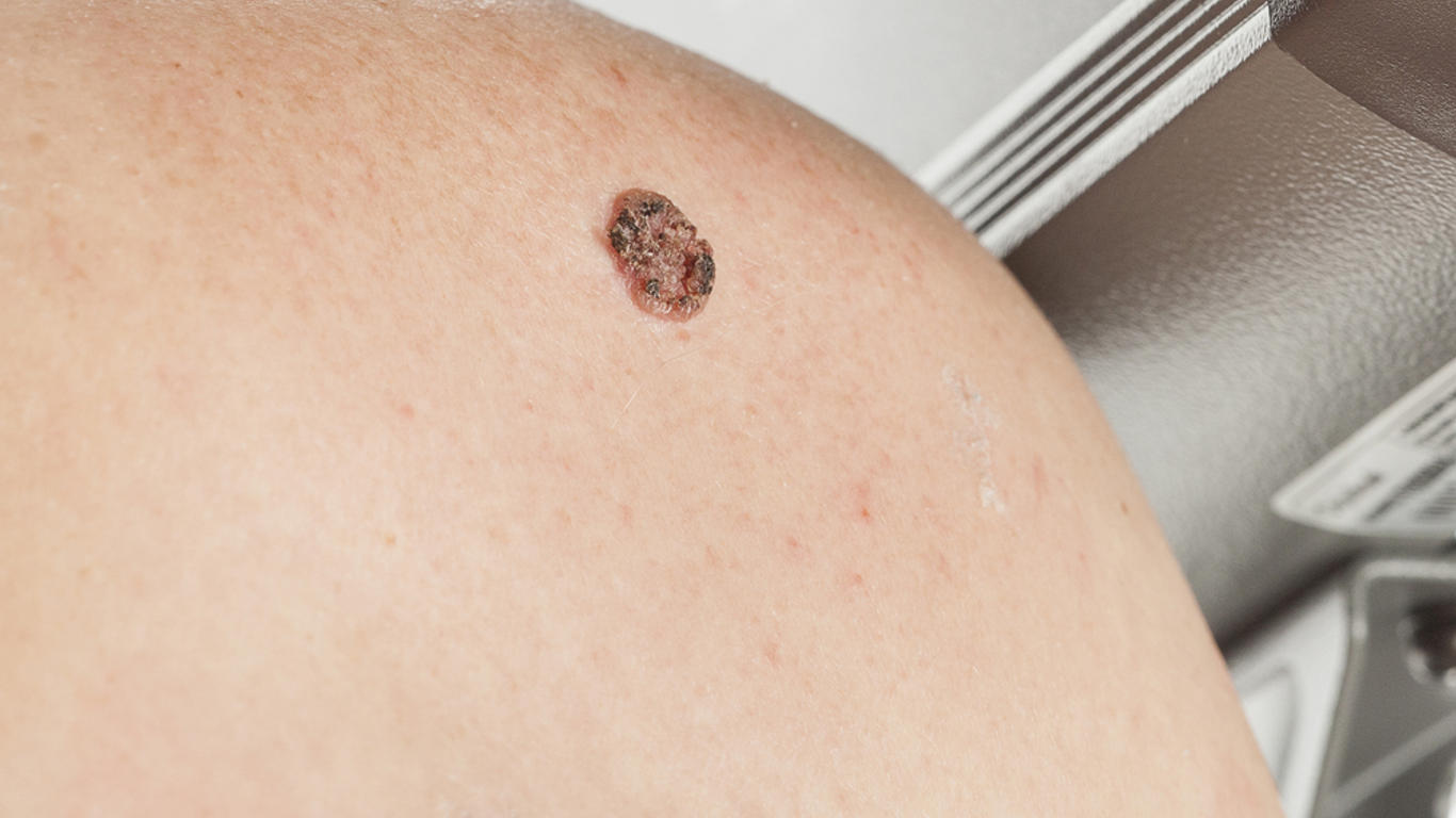 Quelle différence entre un carcinome et un mélanome ? Allo Docteurs — free download