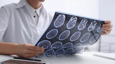 La sclérose en plaque provoque un dérèglement immunitaire qui attaque un prolongement du neurone, avec notamment pour conséquences des troubles moteurs