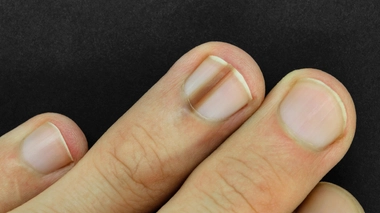 Mélanome de l'ongle : quelle prise en charge ?