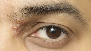 Quels sont les risques liés au zona ophtalmique ?