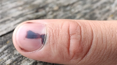 Que faire en cas d'hématome sous l'ongle ?