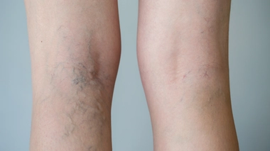 En cas d'insuffisance veineuse, le sang veineux stagne à l'intérieur des petites veines ce qui occasionne des varices.